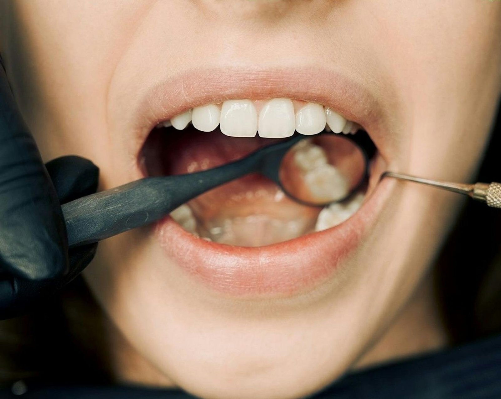 dentist checking teeth of a person